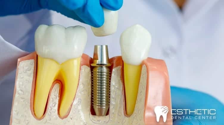 implantes dentales parte 2 1