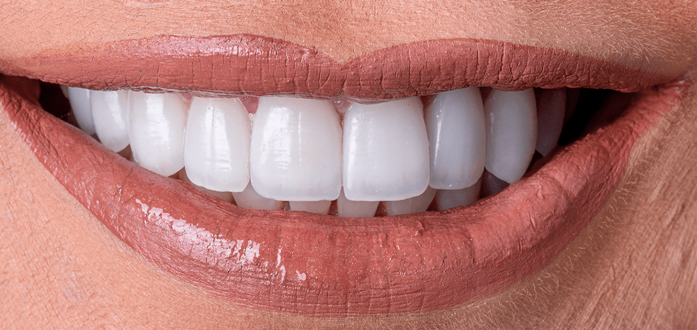 Despues-diseño-de-sonrisa