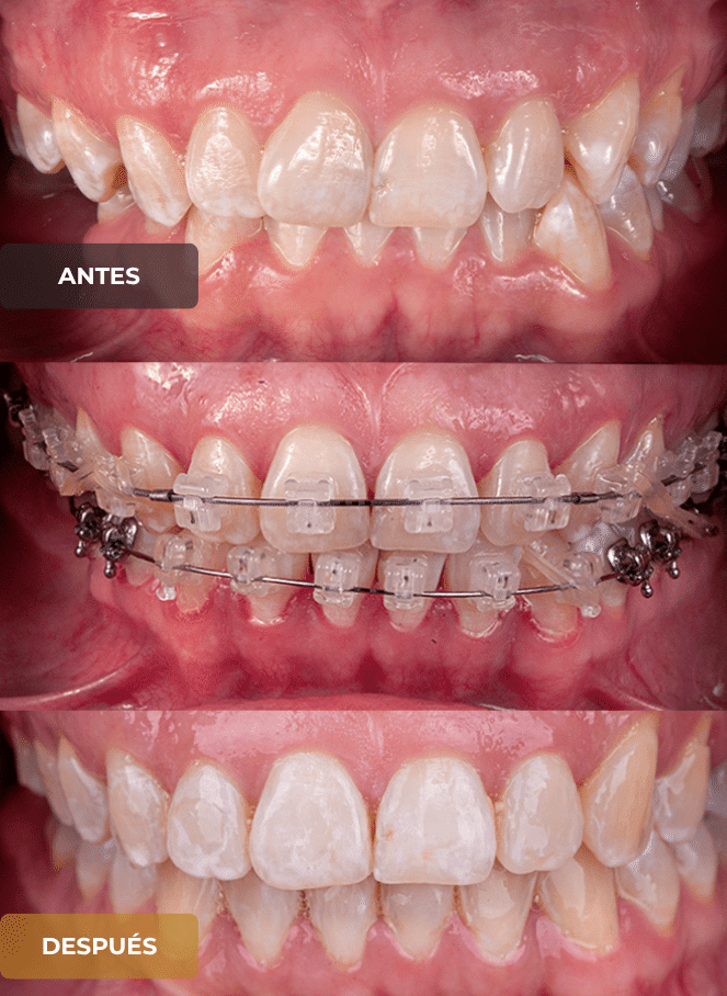 Ortodoncia antes y despues