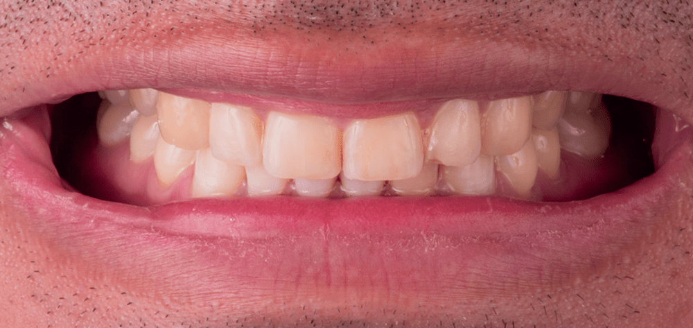 antes-carillas-dentales