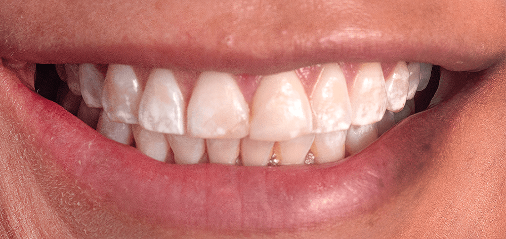 antes-diseño-de-sonrisa