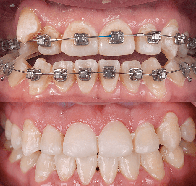 bracketsautoligadoqro | Esthetic Dental Center | Esthetic Dental Center braces queretaro