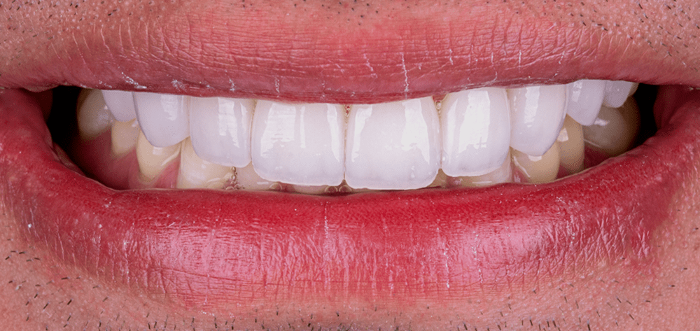 despues-carillas-dentales