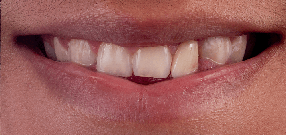 diseño de sonrisa antes diseño de sonrisa antes