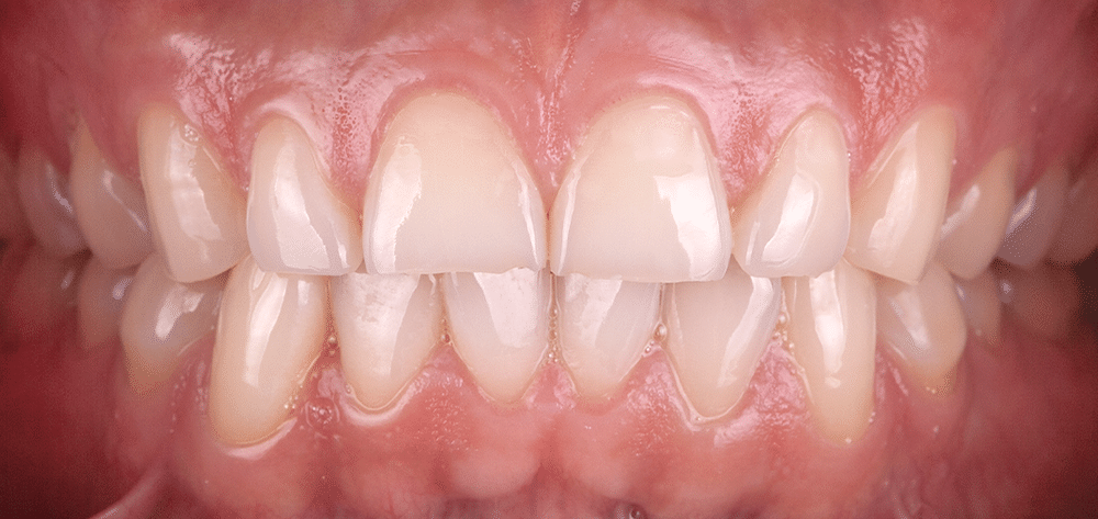 diseno sonrisa antes qro