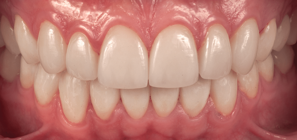 diseno sonrisa despues qro