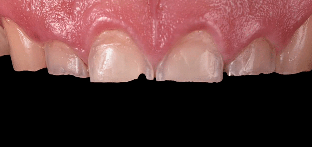 diseno sonrisa qro antes