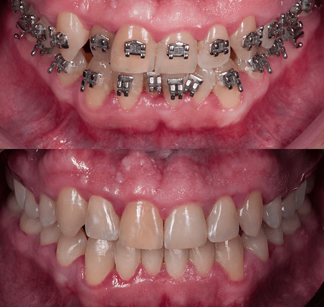 ortodonciaconbraquets | Esthetic Dental Center | Esthetic Dental Center orthodontic braquets