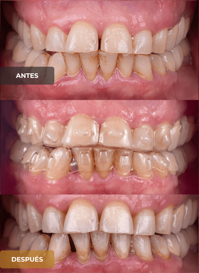 ortodoncia invisible qro