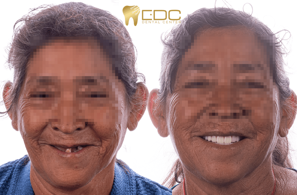 protesis totales qro | Esthetic Dental Center | Esthetic Dental Center protesis totales qro