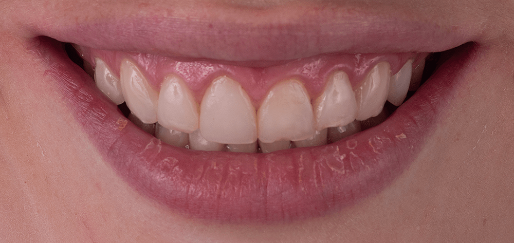 septiembre diseño de sonrisa antes septiembre diseño de sonrisa antes