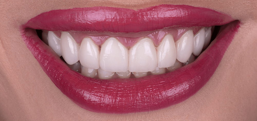 septiembre diseño de sonrisa despues